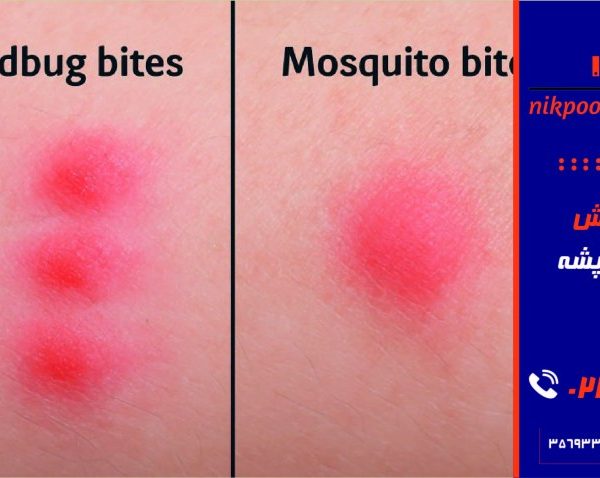 فرق گزش ساس با پشه