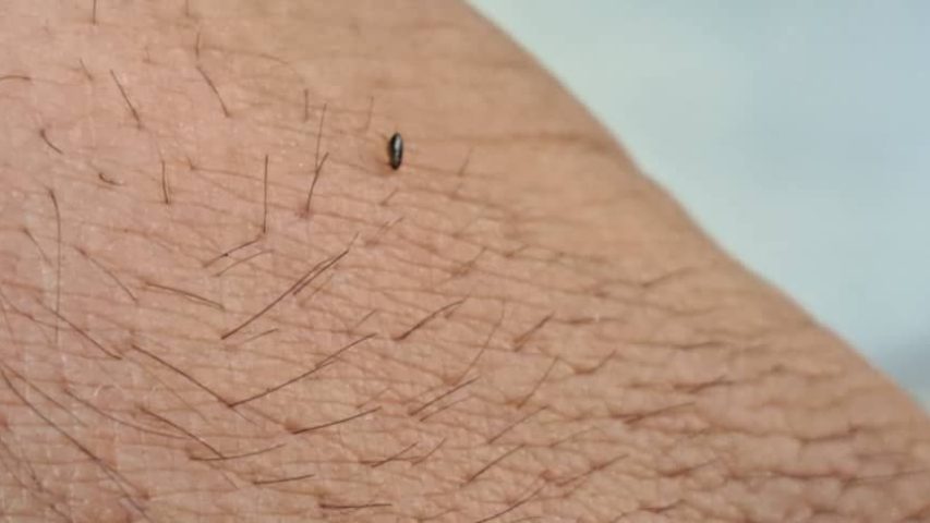 عکس گزش کک روی بدن انسان